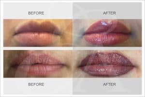 Exclusive Aesthetic SPMU Lip Treatments Before And After