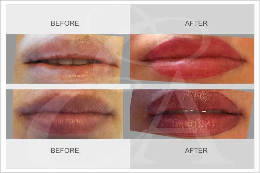 Semi Permanent Lips Makeup procedures in Dubai last up to 3 years. Beautifully shaped lips, always perfect & smudge-free, 24 hours a day.