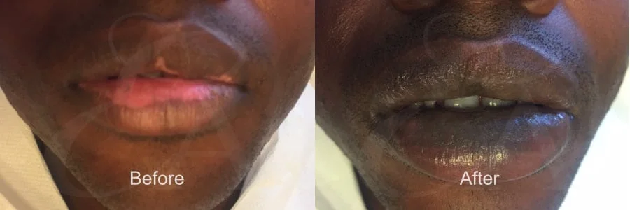 Vitiligo treatment by the experts in Dubai. We offer a very effective Vitiligo treatment helping thousands of people affected by Vitiligo.