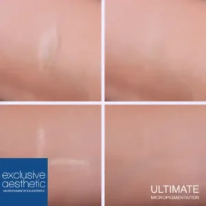 Best Scar Removal Treatment - Skin Camouflage Micropigmentation. Advancements provide effective solutions for scar removal with expert results