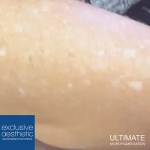 Can Micropigmentation Skin Camouflage Help Hypopigmentation? Skin camouflage Dubai emerges as an effective solution for hypopigmentation.