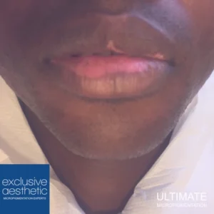 Can Micropigmentation Help With My Vitiligo? Potential to help individuals with vitiligo regain confidence and improve the skin's appearance.