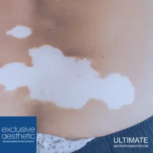 Tattoo Removal Dubai, UAE, by Candice Watson & Exclusive Aesthetic. Remove any colour pigment with safer results than laser tattoo removal.