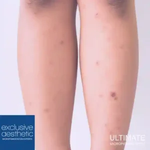 Can I Undergo MCA Scar Treatment If I Have Sensitive Skin? MCA scar treatment is an effective method for reducing the appearance of scars.