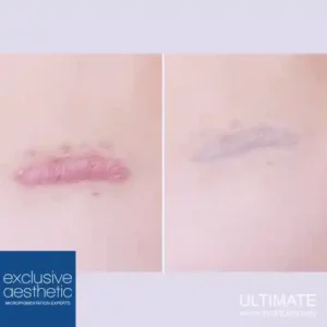 Keloid Scar Treatment in Dubai: A Comprehensive Guide. Discover best options for treating keloid scars in Dubai with FAQs & expert insights.