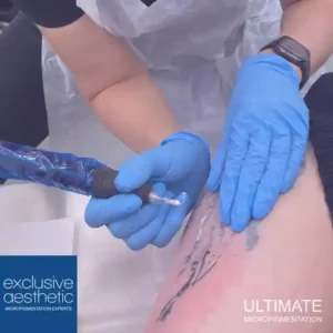 Tattoo Removal Dubai: How To Remove A Tattoo Using The Rejuvi Method Of Tattoo Removal? Explore how Rejuvi Removals can remove unwanted ink.