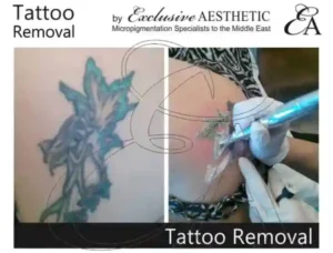 Tattoo Removal Dubai - Why Rejuvi Tattoo Removal Is The Go To Removal Treatment. Finding the right tattoo removal treatment is vital in Dubai